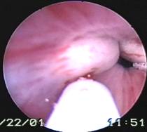 The same patient after UROCOL injection