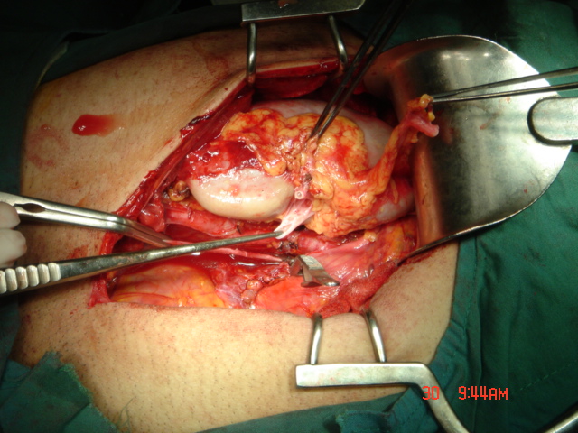 up side down kidney transplant 001.jpg